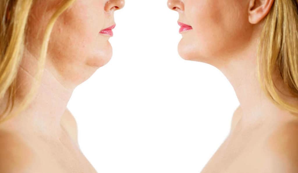 Double Chin treatment Greater London (Camden) before and after results