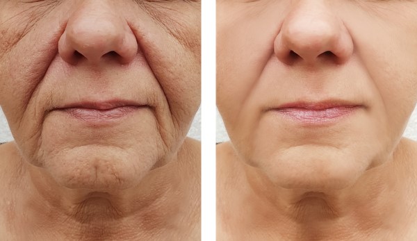 Learn more about Morpheus8 Treatment Greater London (Camden) today!