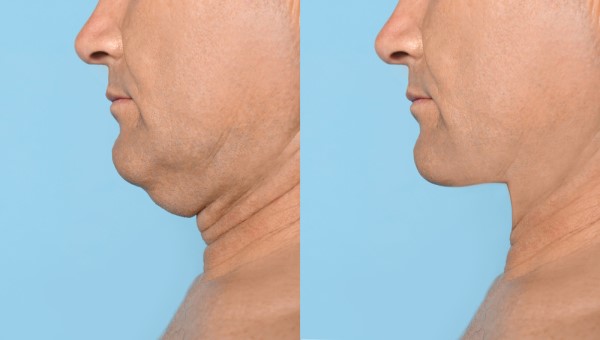 Which Non-Surgical Treatments Work Best for Jowls and Loose Skin Greater London (Camden)?