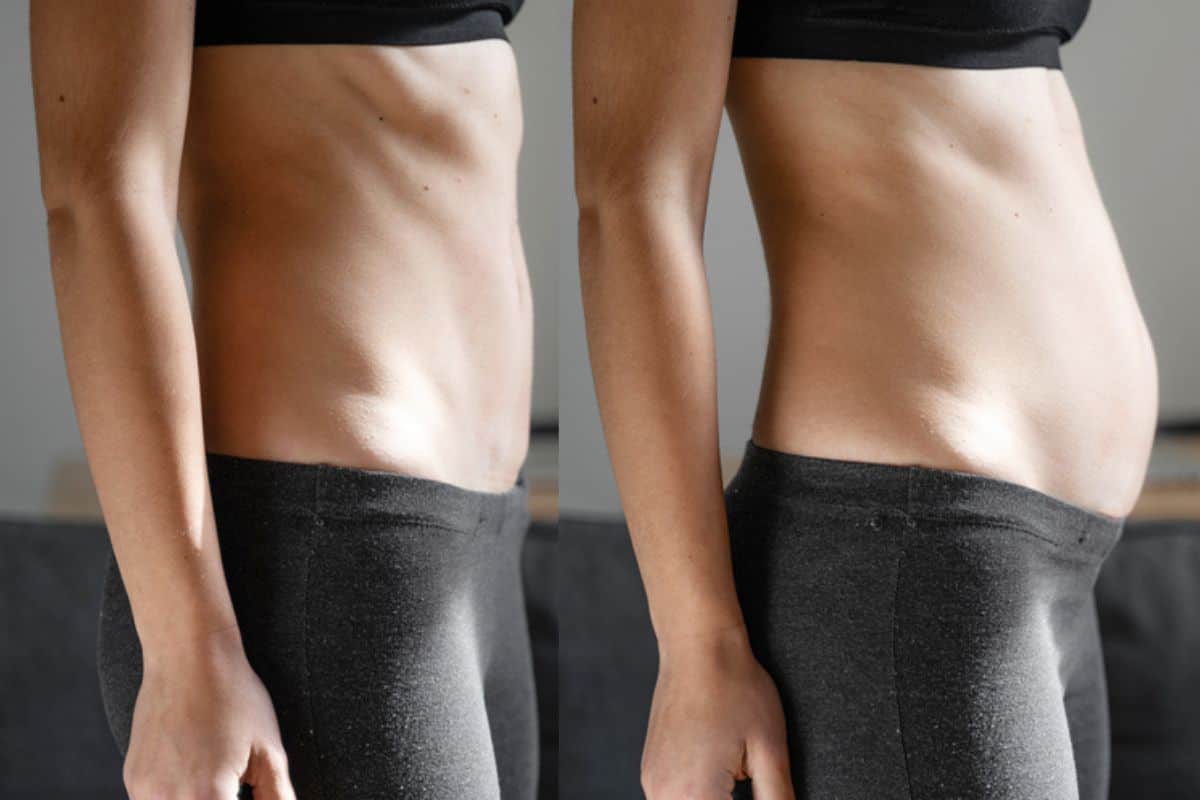 How long does diastasis recti take to improve Greater London (Camden)?