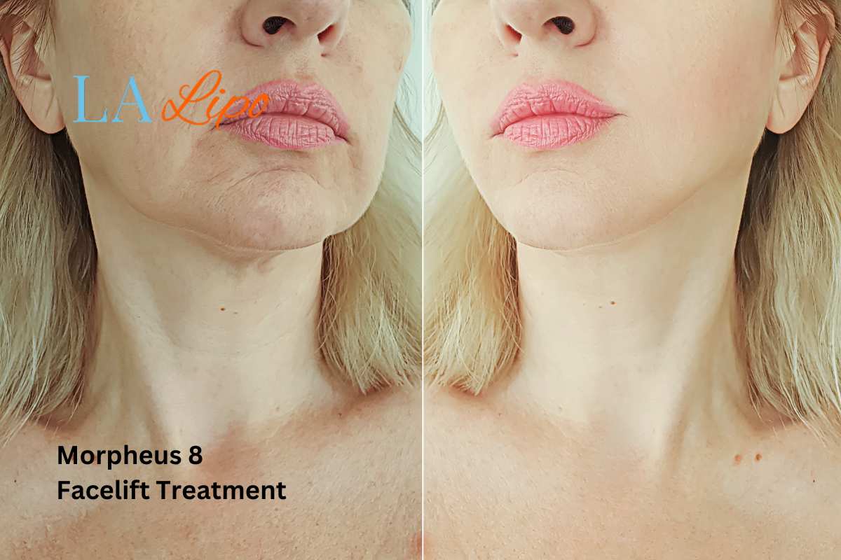 Turn back time with Morpheus8 Treatment Greater London (Camden)