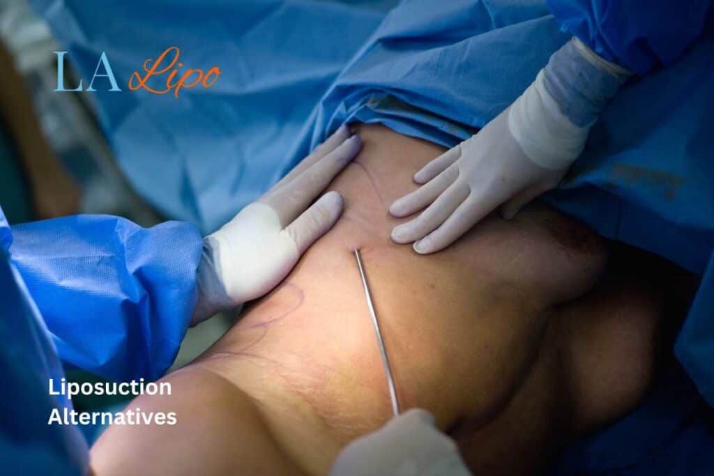 liposuction