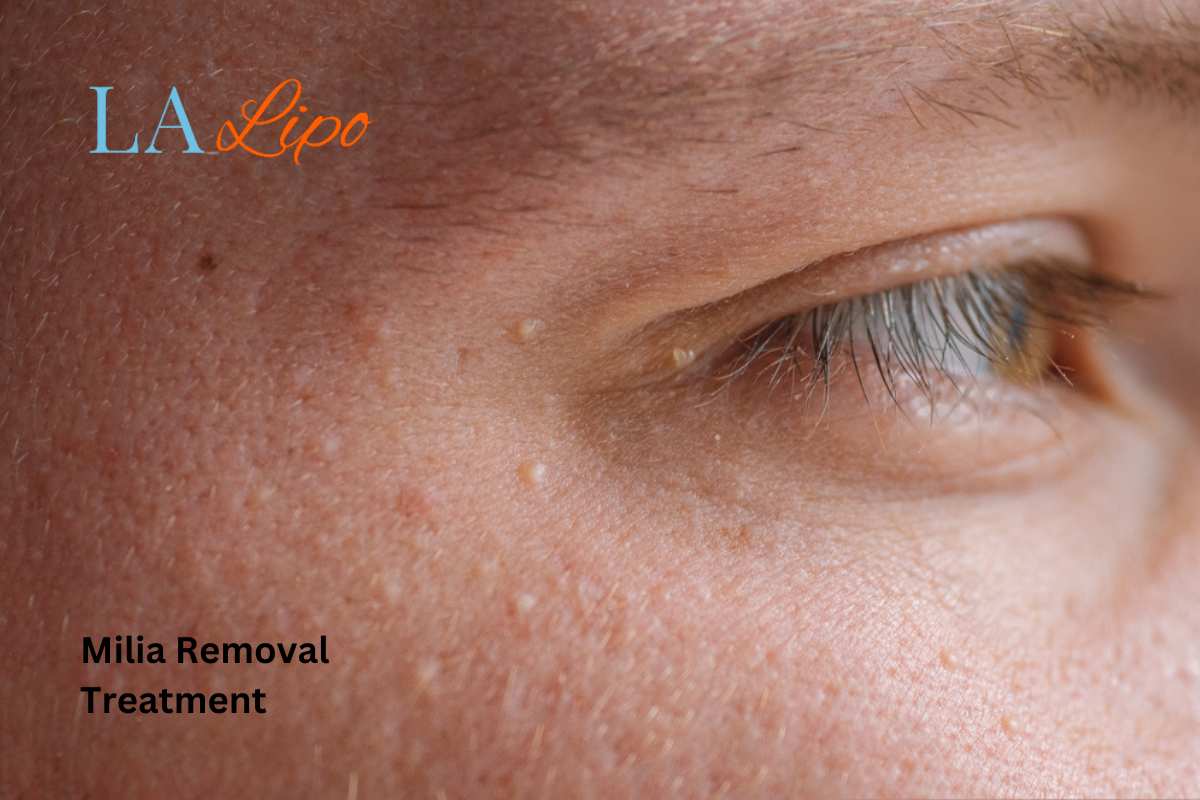 Cryopen Milia Removal: Is It the Easiest and Safest Option Greater London (Camden)?