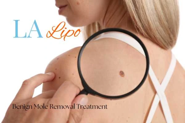 Woman having her inspection of blemish before mole removal Greater London (Camden)