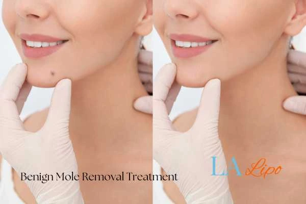 woman's before and after mole removal Greater London (Camden) results