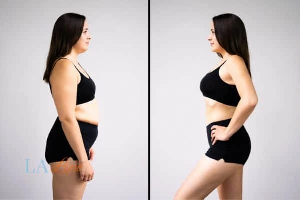 image of woman before and after results of LA-EMS Body Sculpting Greater London (Camden) to help treat Diastasis recti