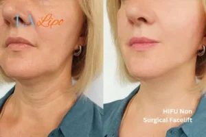 hi-fu for wrinkles Greater London (Camden) before and after results