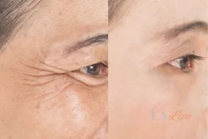 Before and after results of woman - HI-fu wrinkles reduction treatment Greater London (Camden)