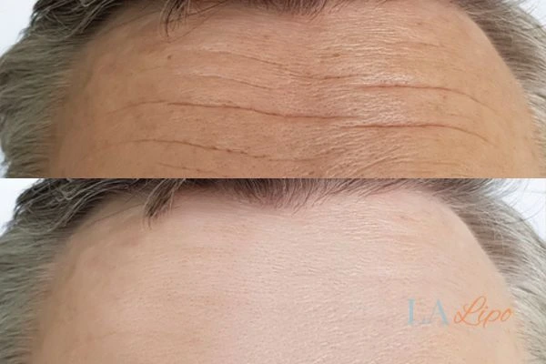 results of HIFU Greater London (Camden) on mans forehead to help reduce lines and wrinkles