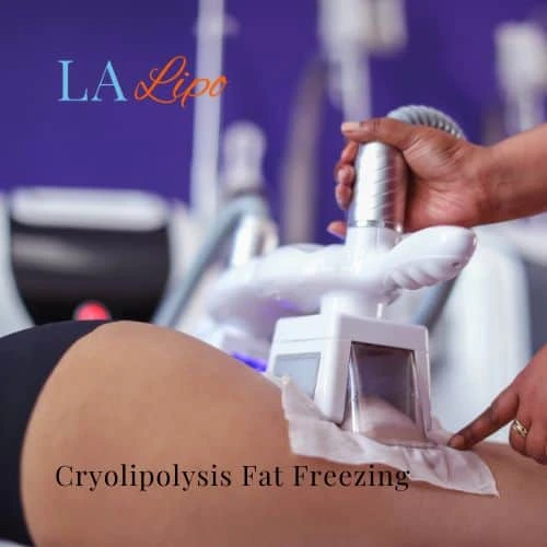 fat freezing - Cryolipolysis Greater London (Camden)