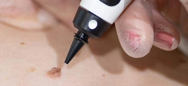 skin tag removal using cryopen Greater London (Camden)