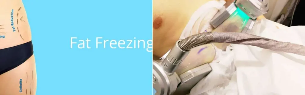 Fat freezing Greater London (Camden) on multiple areas of the body