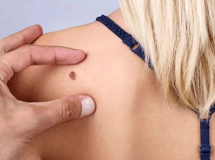 woman having mole removal Greater London (Camden) consultation before treatment.