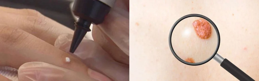 Person getting moles removed with cryopen Greater London (Camden)