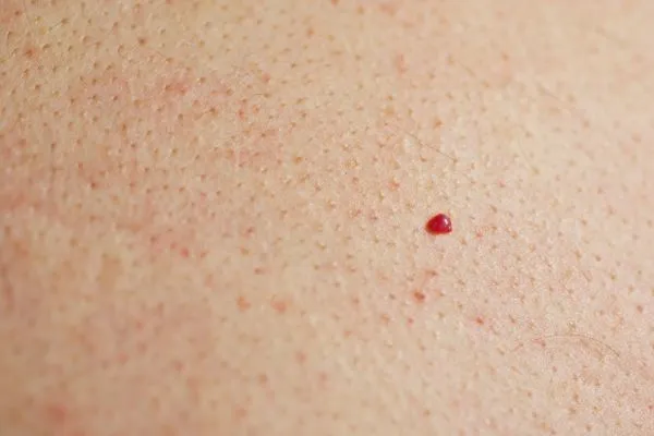 close up of a cherry angioma Greater London (Camden)