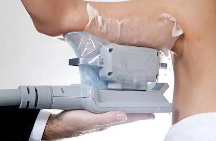 Picture of fat freezing Greater London (Camden) on the upper arms.