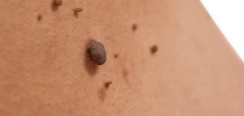 image of a skin tag Greater London (Camden)