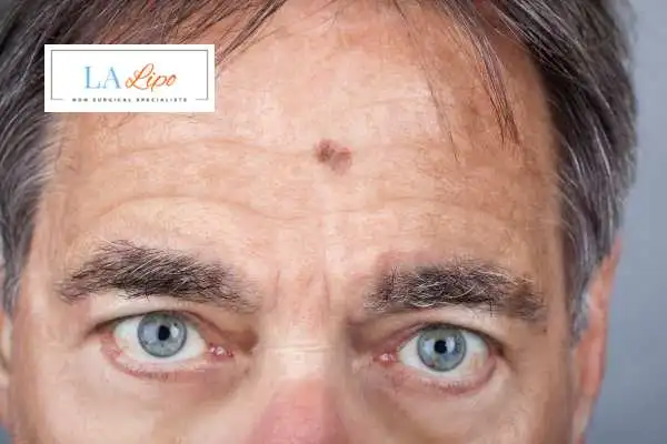 Solar Lentigo Removal Greater London (Camden) image of man with mark on his forehead