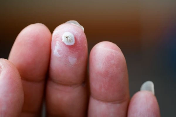 wart on person finger - cryotherapy to treat from LA LIPO Greater London (Camden)