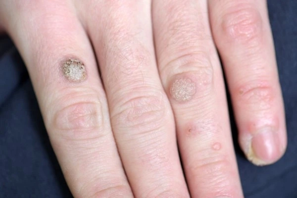 photo of warts on person hand - see wart removal Greater London (Camden) from LA LIPO