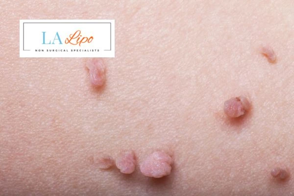 Does cryopen skin tag removal Greater London (Camden) hurt? Find out now call our team today!