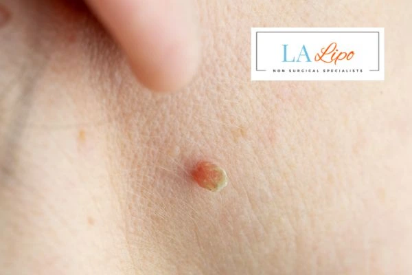 Book skin tag removal Greater London (Camden) today speak to our team now!