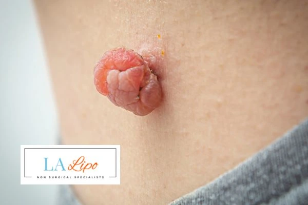 Interested in skin tag removal Greater London (Camden)? Concerned about the pain? Find out more today!