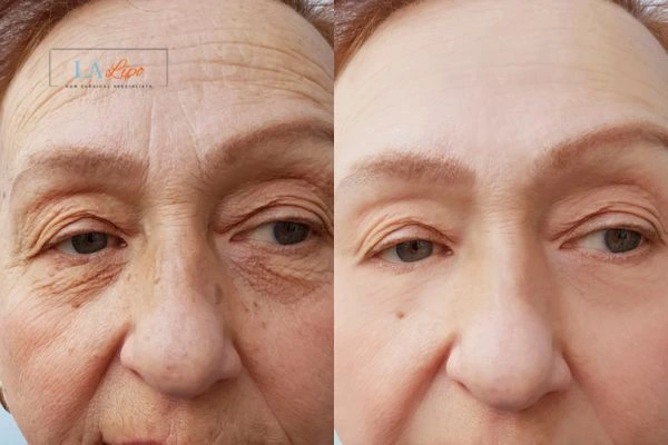 The powerful benefits of Morpheus8 Treatment Greater London (Camden) - Call Our team today!