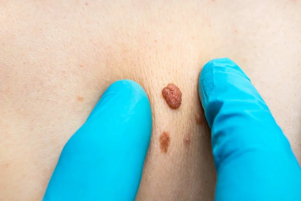 LA LIPO Cryopen Lesion Removal Prices Greater London (Camden)