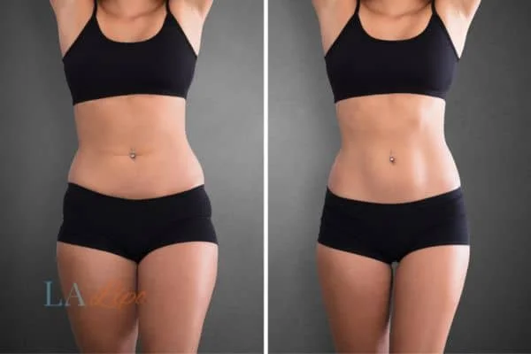 before and after results of non-surgical treatment to help a woman's body image and mental health Greater London (Camden)