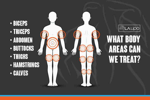 Diagram to show areas you can have LA-EMS Body Sculpting Treatment Greater London (Camden)