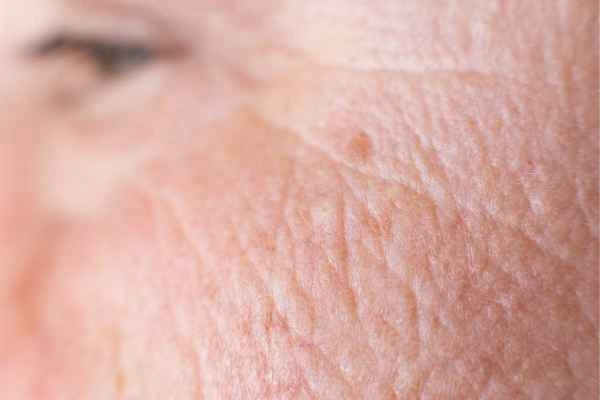 close up picture of a woman's face showing an age spot Greater London (Camden)