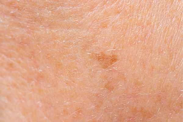 close up picture of age spots Greater London (Camden)