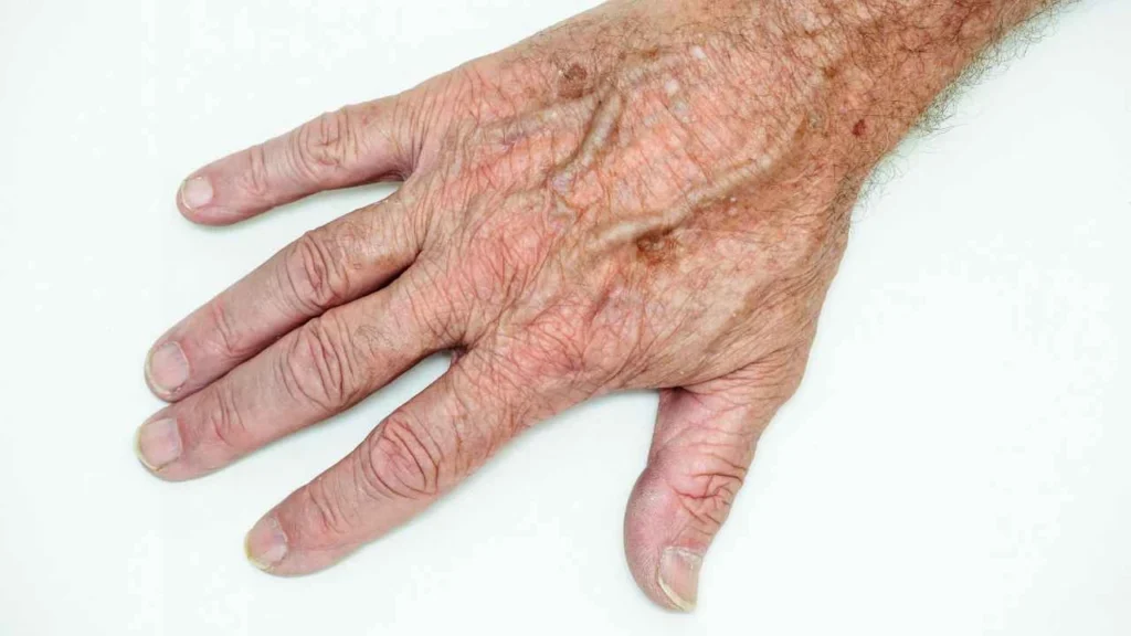 Male hand showing age spot Greater London (Camden)