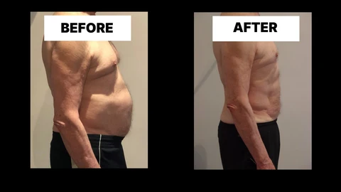What Symptoms Can Diastasis Recti Cause in Men? Weak Core, Back Pain and Poor Posture Greater London (Camden)
